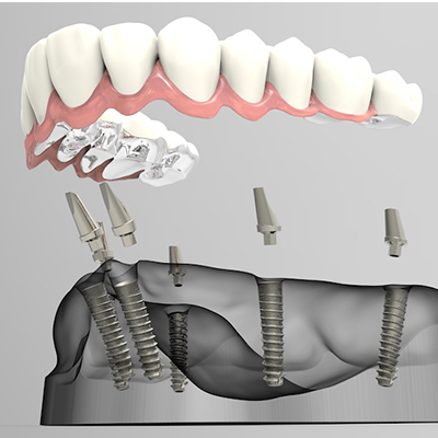 Dental Implant:Tooth Replacement that Lasts