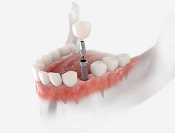 Factors that Affect the Cost of Dental Implants ​