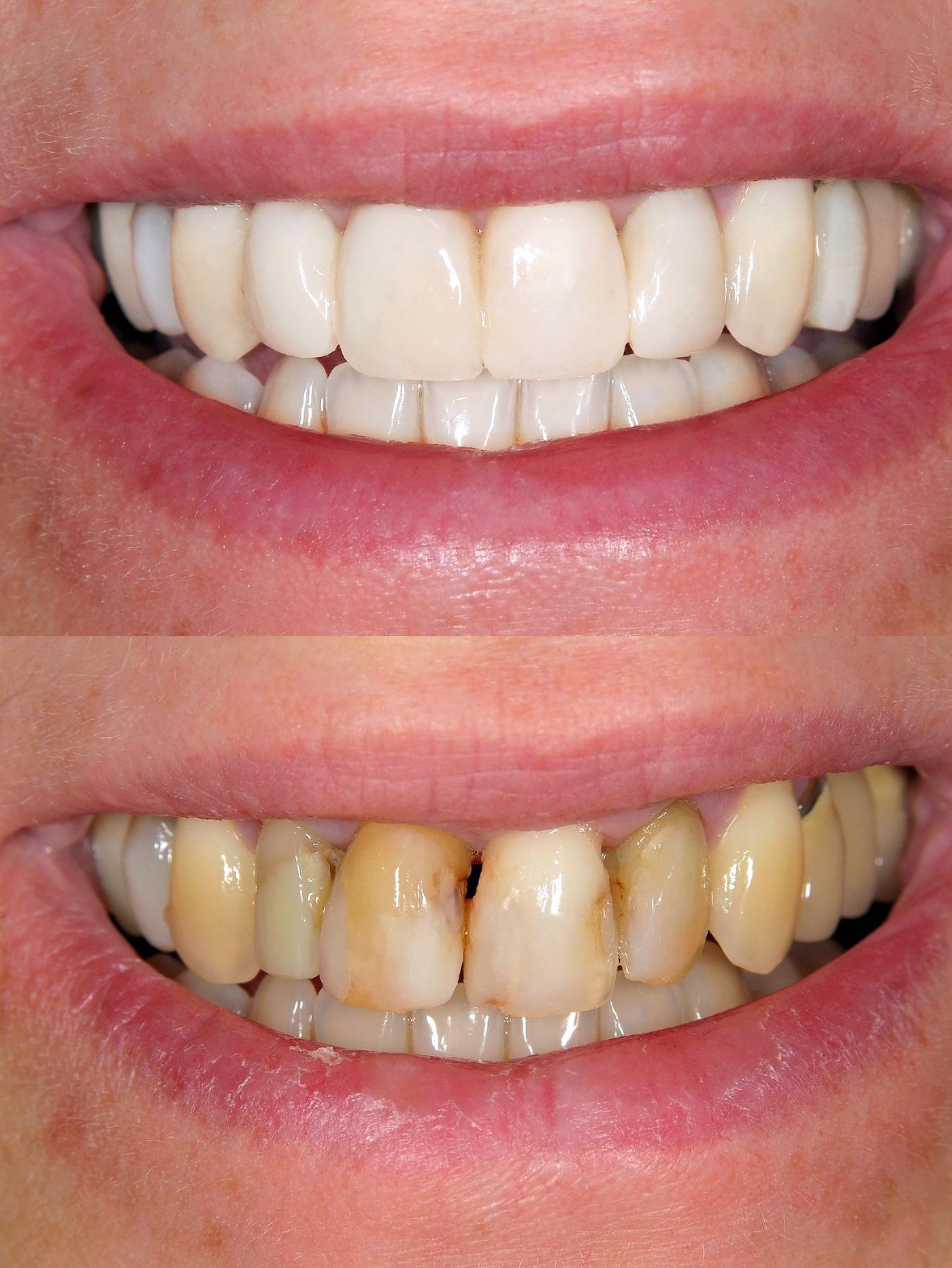 Veneers Before and After​