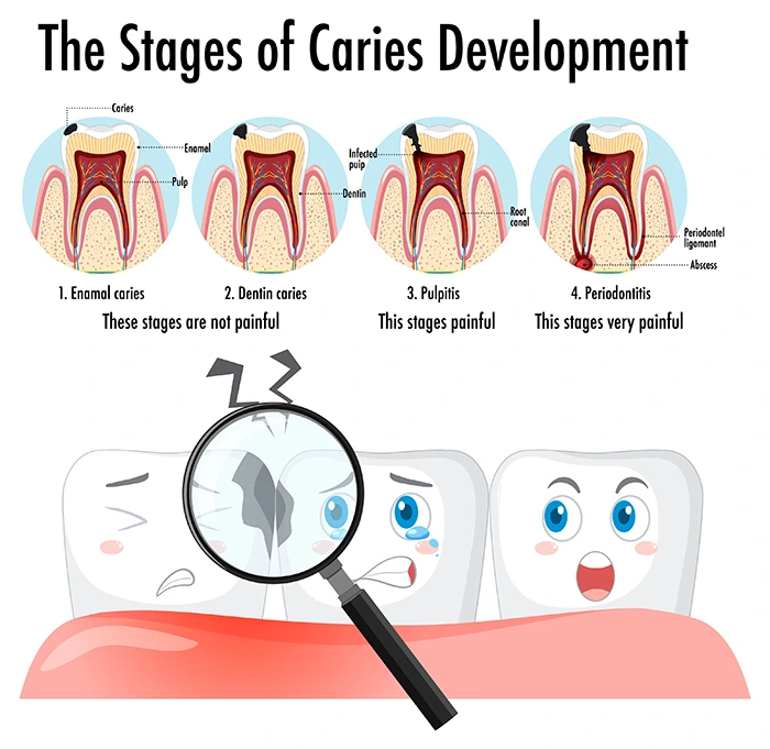 Root Canal Treatment Explained​
