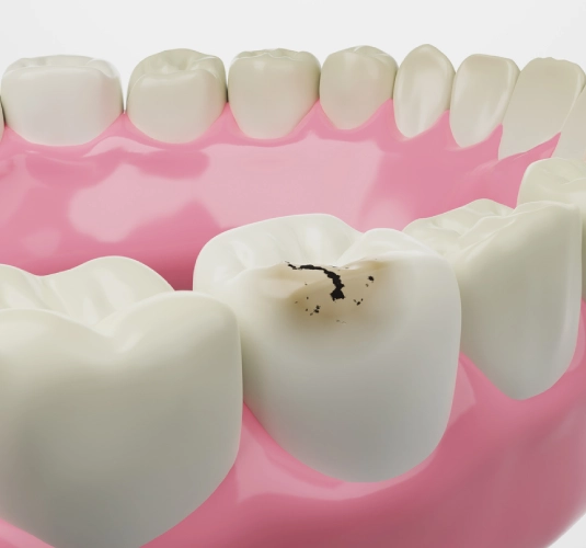Detecting Early Signs of Tooth Decay