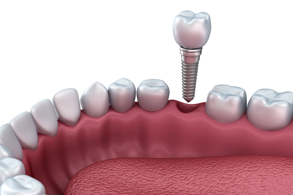How Painful Is Getting A dental implant